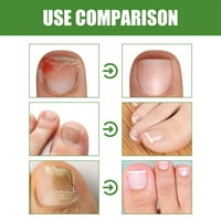 Valjak za nokte na noktima siva popravka noktiju omekšavajući uklanjanje noktiju zadebljanje noktiju za nokti hranjivo